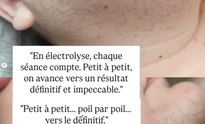 Épilation électrique haute fréquence visage à Genas, Chassieu, Emilie Valenciano - Eau'natur'elle